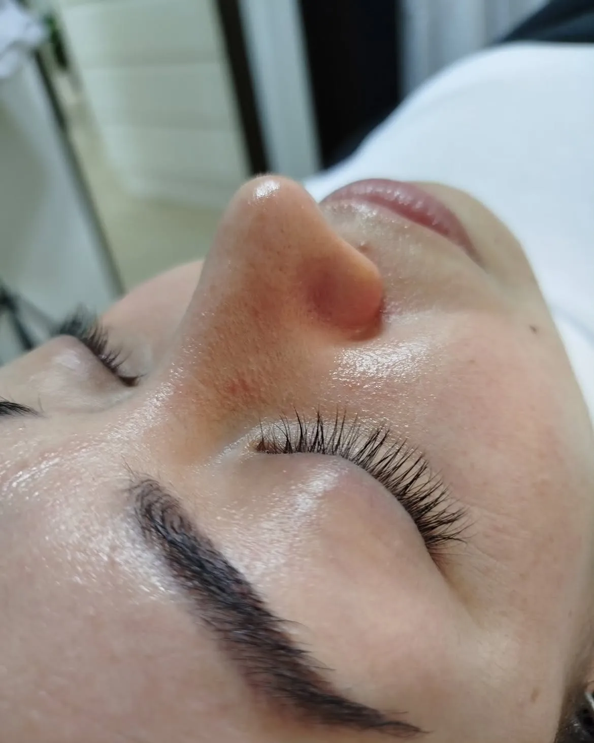 Después de tratamiento facial